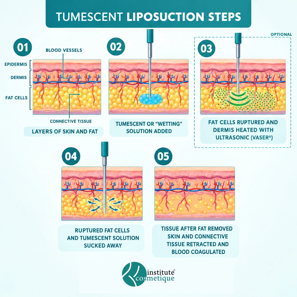Liposuction Treatment